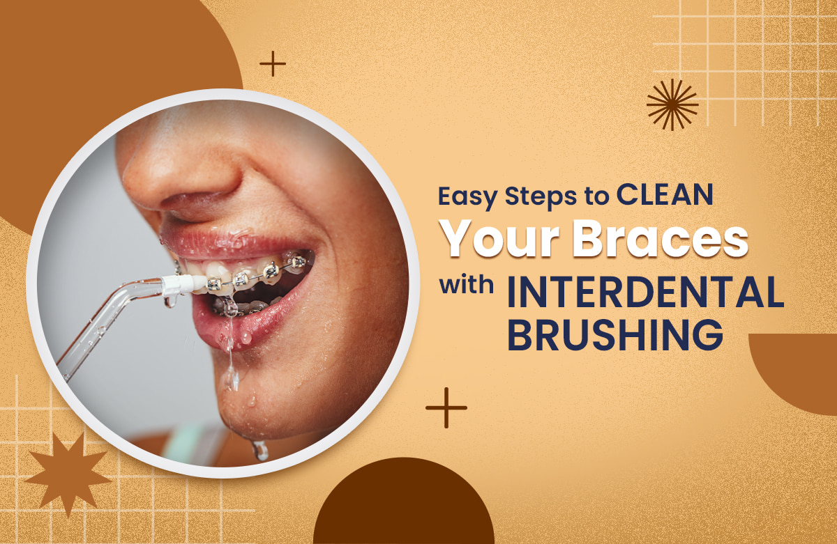 Easy Steps to Clean Your Braces with Interdental Brushing